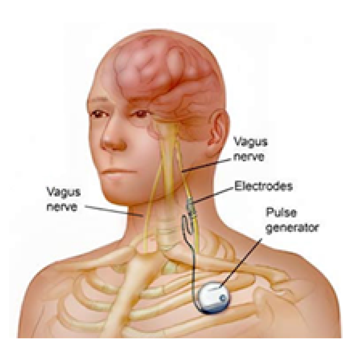 Read more about the article Modeling Vagus Nerve Stimulation